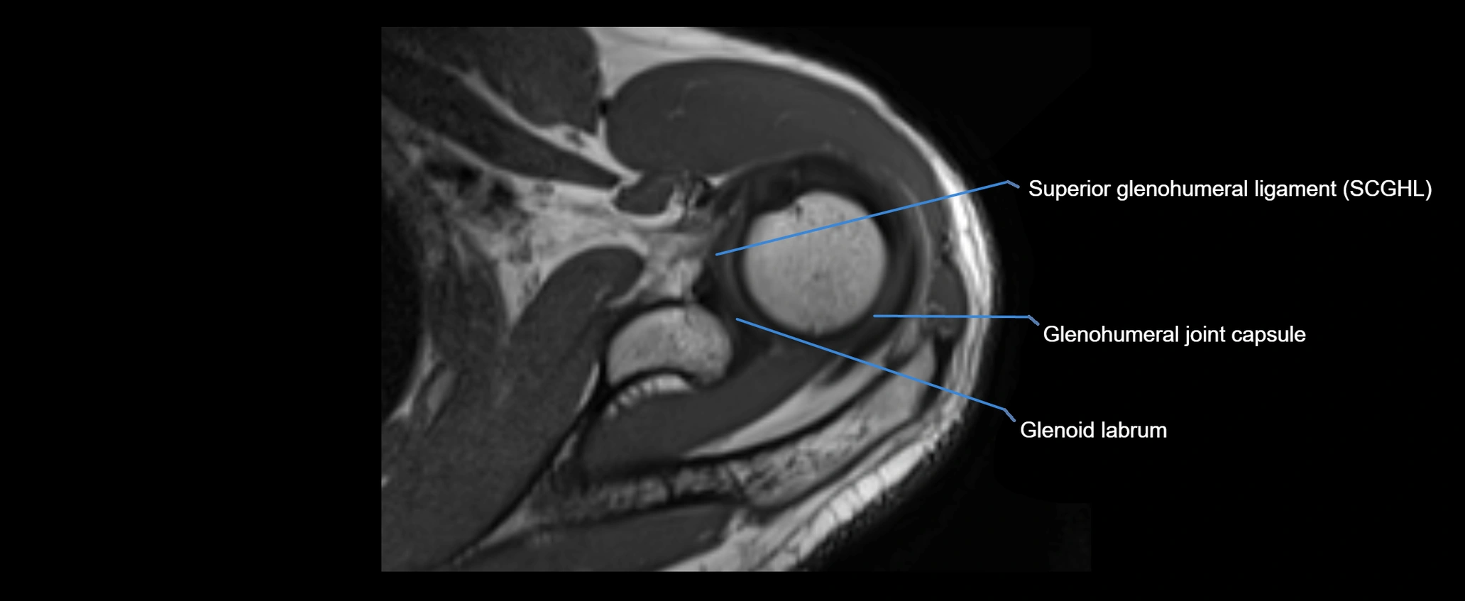 shoulder ligaments axial 3d 3t mri image-img-00005-00047.webp